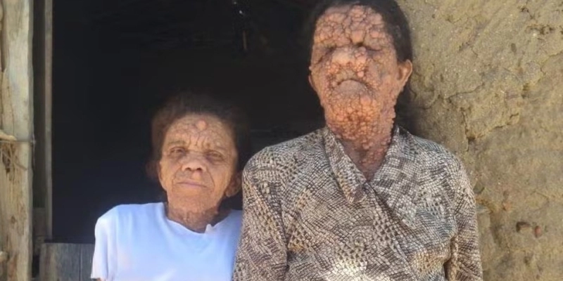 Mãe e filha vivem com doença genética rara, na Paraíba - Arquivo Pessoal / Edilson Filho