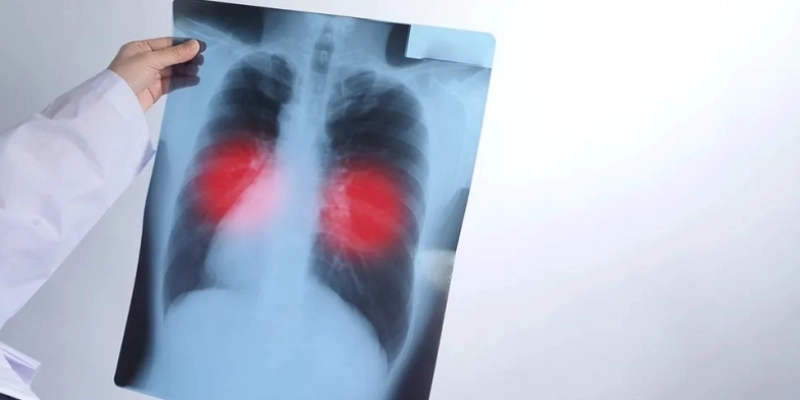 Os principais da tuberculose são: tosse - que pode ser acompanhada de sangue -, febre, sudorese e perda de peso - Freepik