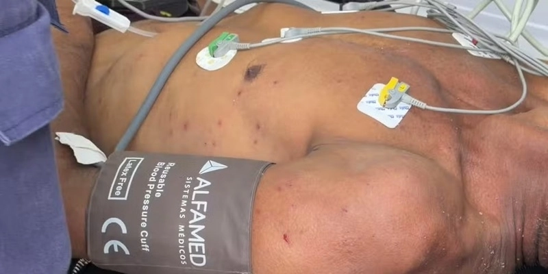 Homem é picado mais de 100 vezes em ataque de abelhas, na PB - Flávio Fernandes - TV Cabo Branco